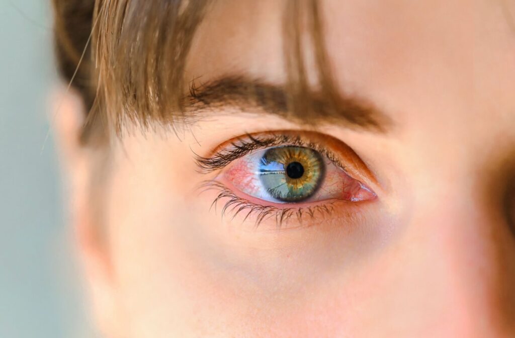 Close-up of an eye that's red due to pink eye or another condition.