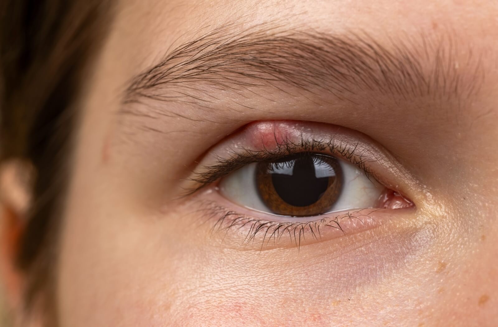Close-up of a human eye with a red, swollen bump on the upper eyelid, showing signs of a stye or eyelid infection.
